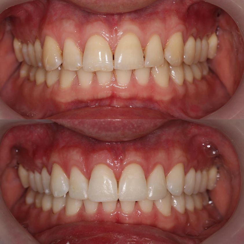 Leczenie zgryzu i startych zębów