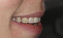 Niewidzialna ortodoncja - Alignery