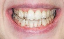 Proste zęby i piękny uśmiech ClearAligner